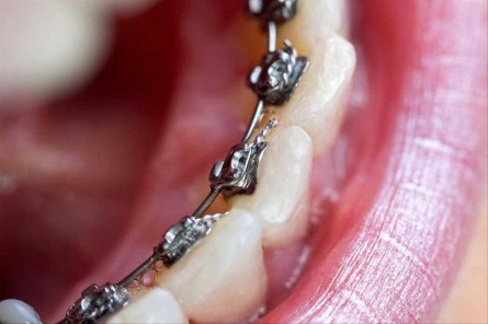 Sabit Ortodontik Tedaviler